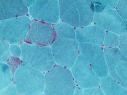 Hücresel Yapılardaki Bozuklukların Neden Olduğu Kalıtsal Hastalıklar