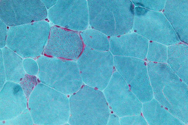 Hücresel Yapılardaki Bozuklukların Neden Olduğu Kalıtsal Hastalıklar